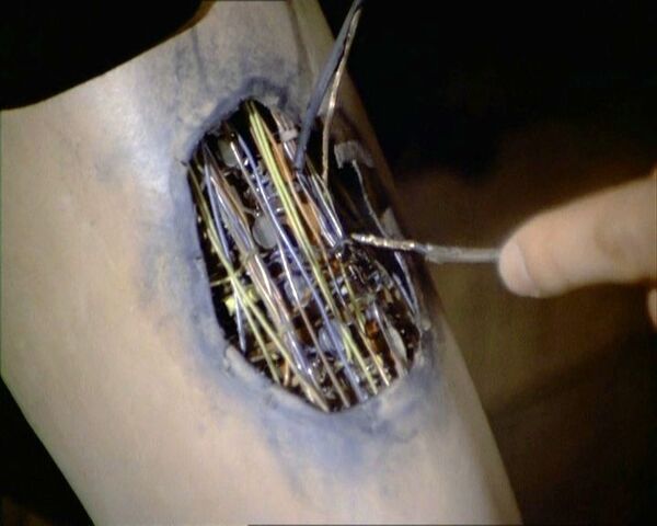 File:Jaime leg repair.jpg