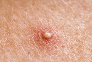 Whitehead-zit