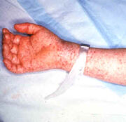 Rocky mountian spotted fever