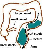 overflow incontinence overflow incontinence