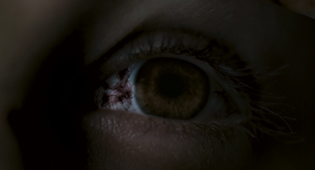 File:AndyBloodshotEye.png