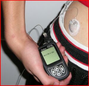 Insulin pump with infusion set