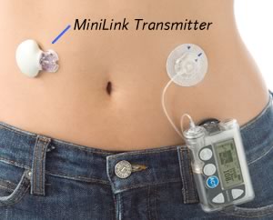 Medtronic Artificial Pancreas >> Development of Continuous Glucose Monitoring Systems (CGMS ... Medtronic Artificial Pancreas >> Development of Continuous Glucose Monitoring Systems (CGMS ...