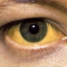 Arquivo:Jaundice.jpg