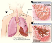 Pneumonia.jpg