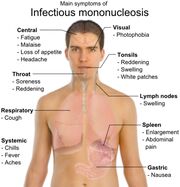 Virus-de-epstein-barr-5.jpg