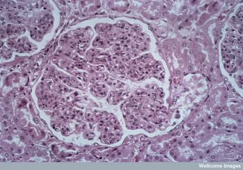 Glomerulonefrite.jpg