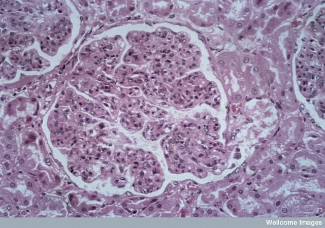 Ficheiro:Glomerulonefrite.jpg.jpg