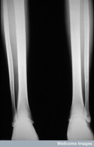 Ficheiro:Radiografia criança com escorbuto.jpg