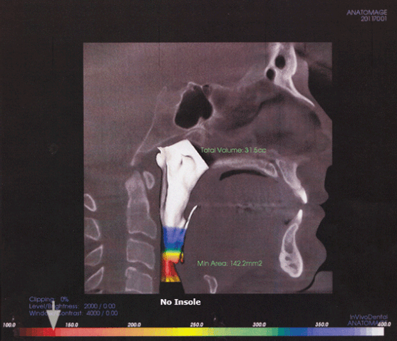 File:Animation Esophageal-Airway-Clearances.gif