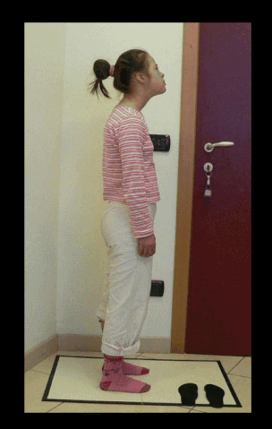 File:Downs patient.gif