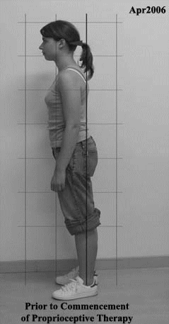 Correctionfwdrotatedposture