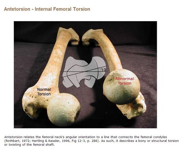 File:Antetorsion - photos of femoral neck's angular orientation.jpg