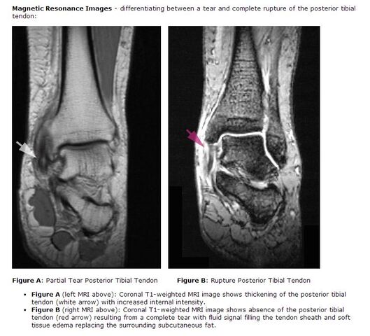 File:PTTD MRI Info.jpg