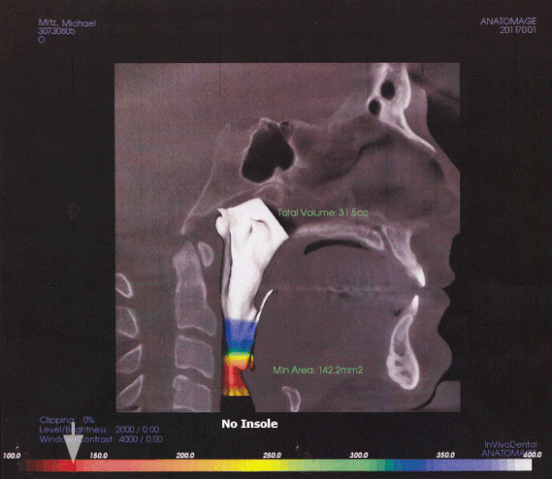 File:Airway Clearance.gif