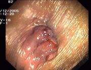 Hemorrhoids2