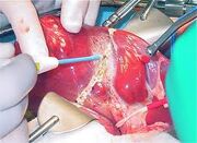Electrocautery