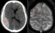 CT TBI