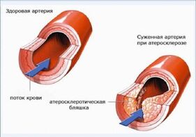 Атеросклероз