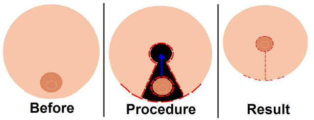 File:Breastreduction.png