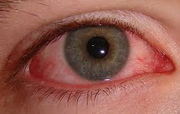 Bloodshot eye