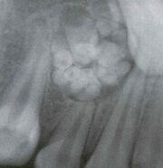 Odontom
