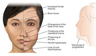 Acromegaly page facial features