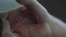Handburn