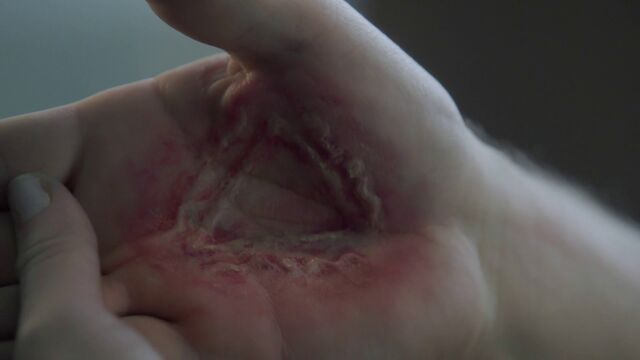 File:Handburn.jpg