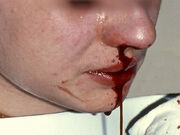 800px-Epistaxis1