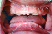 Denture-02-before