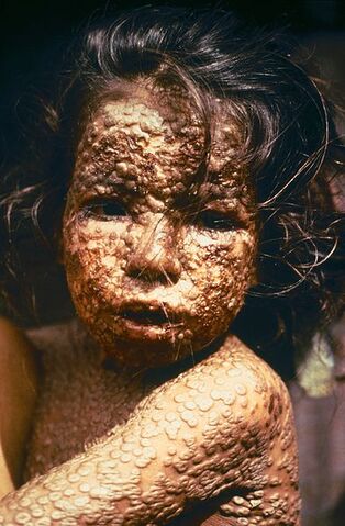 File:Small pox.jpg