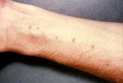 Schistosomiasis itch