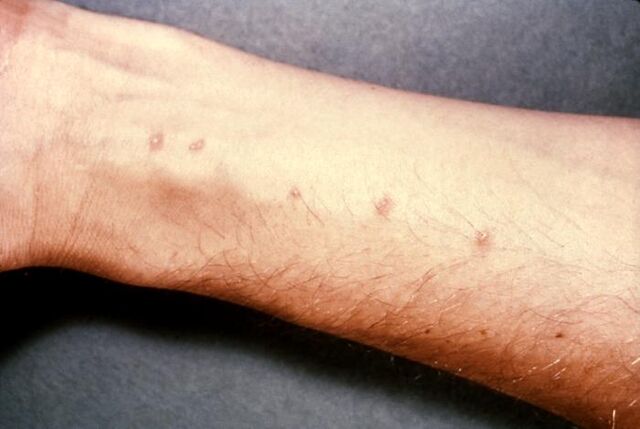 File:Schistosomiasis itch.jpg