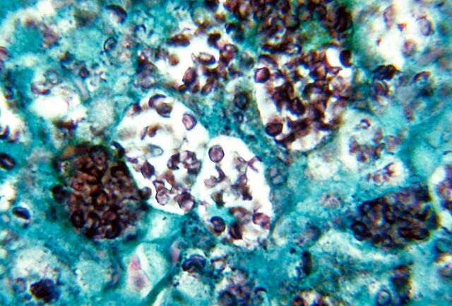 File:Histoplasmosis capsulatum.jpg