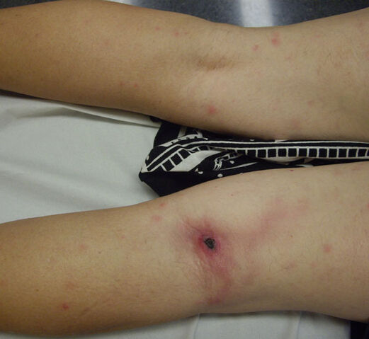 File:Inoculation eschar Rickettsia sibirica mongolitimonae infection.jpg