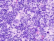 Hodgkin lymphoma (1) mixed cellulary type