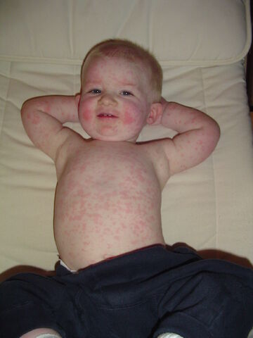 File:Fifth disease.jpg