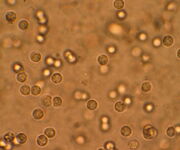 Pyuria