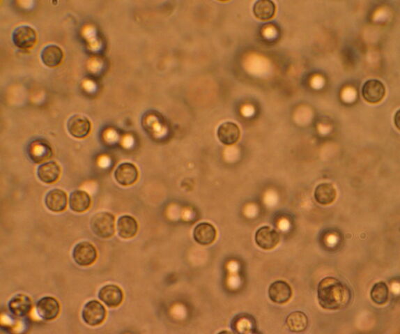 File:Pyuria.jpg