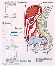 Peritoneal-dialyse.png