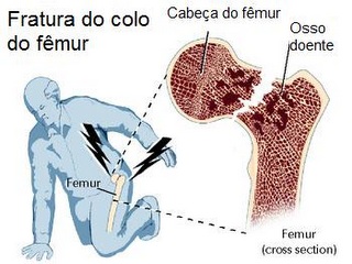 Osteoporose3.jpg