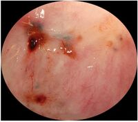 Endometriose fig3.jpg