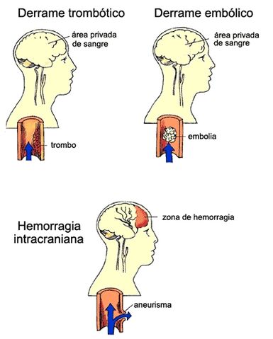 Arquivo:AVC11.jpg