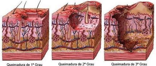 Graus queimadura.jpg