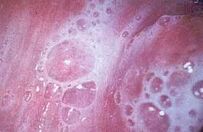Vulvovaginites1