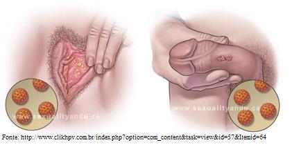 Arquivo:Figura4 HPV.jpg