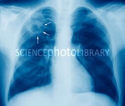 Tuberculose5.jpg
