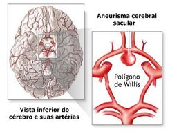 Aneurisma3.jpg