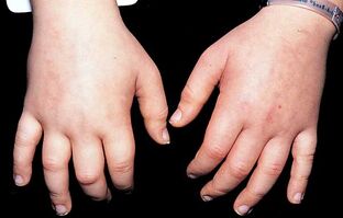 Edema.jpg